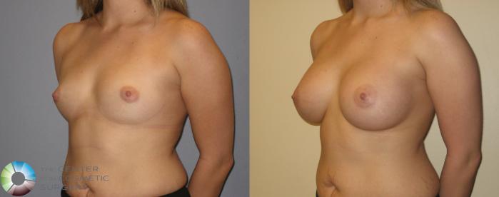 Before & After Breast Augmentation Case 137 View #1 in Denver, CO