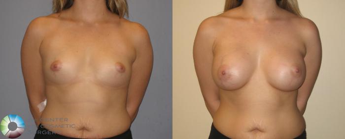 Before & After Breast Augmentation Case 137 View #2 in Denver, CO