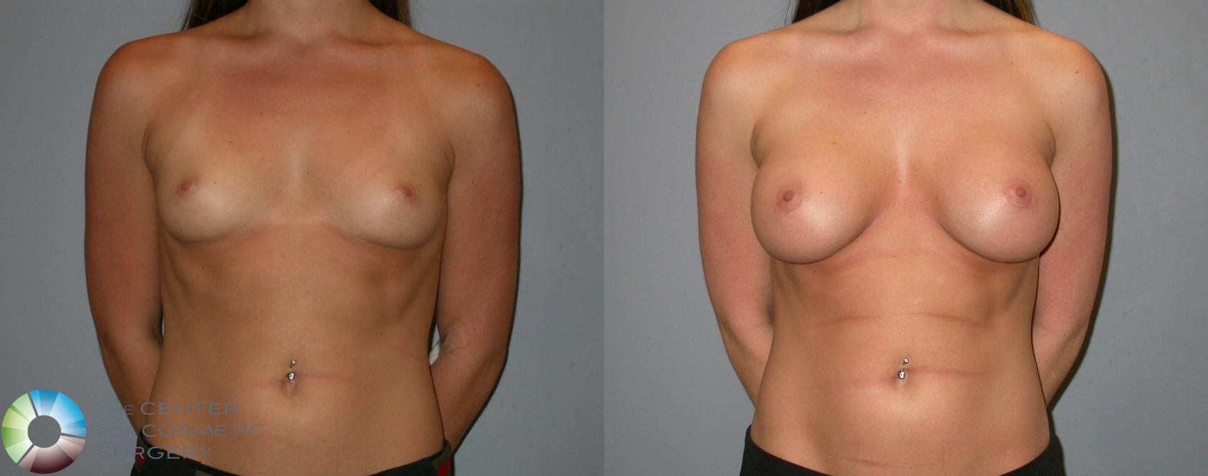 Before & After Breast Augmentation Case 138 View #1 in Denver and Colorado Springs, CO