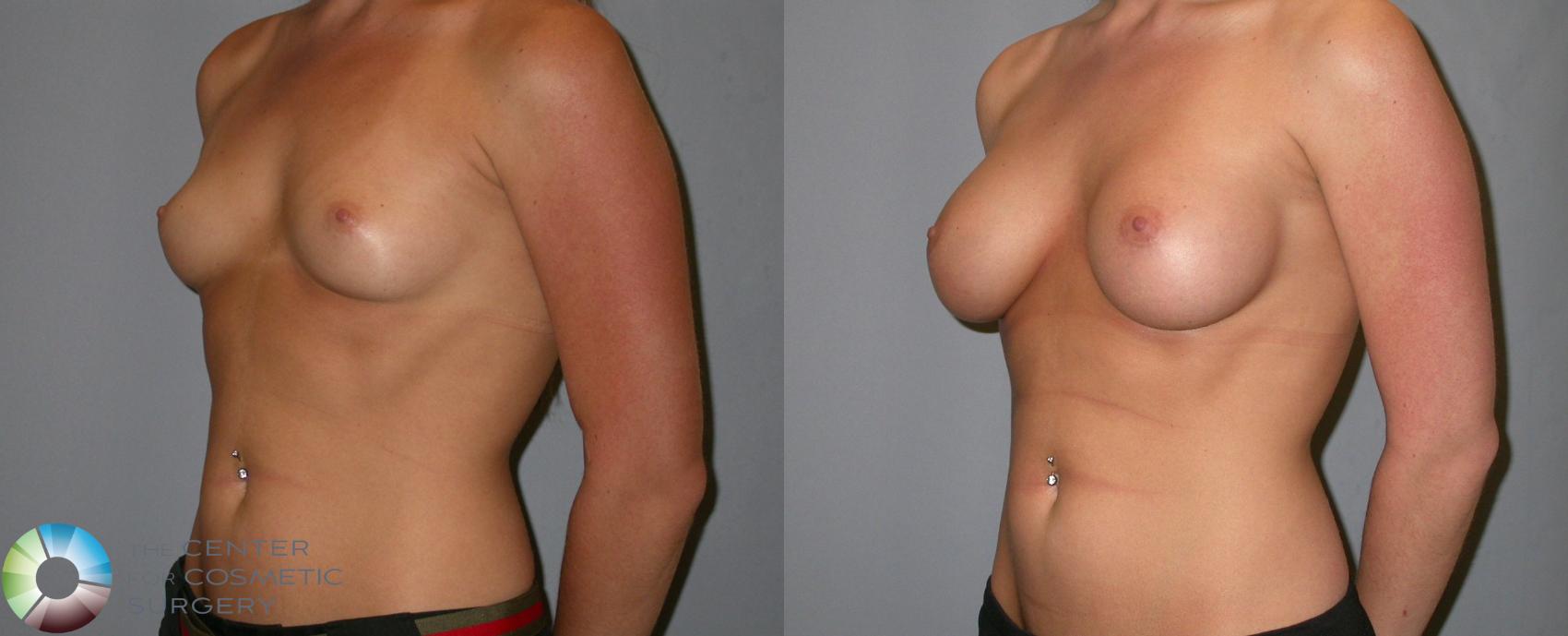 Before & After Breast Augmentation Case 138 View #2 View in Golden, CO