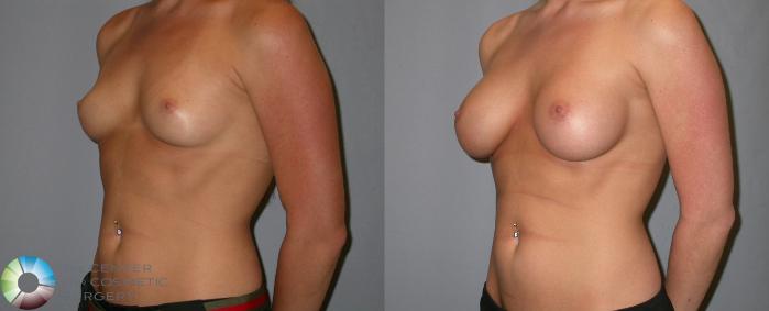 Before & After Breast Augmentation Case 138 View #2 in Denver and Colorado Springs, CO