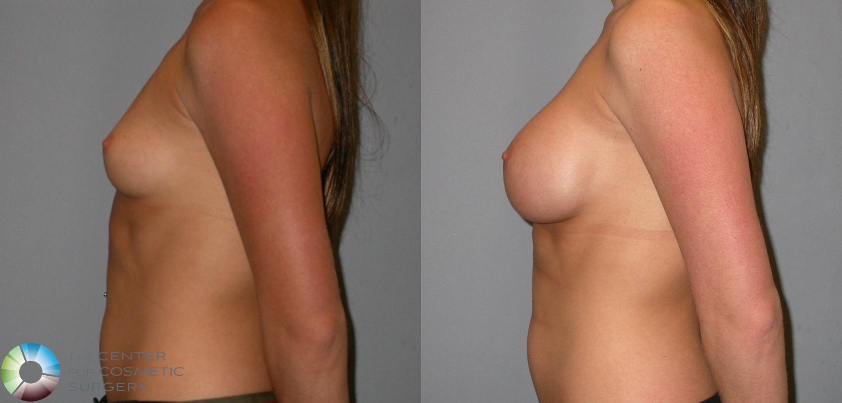 Before & After Breast Augmentation Case 138 View #3 View in Golden, CO