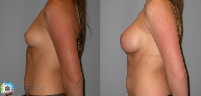 Before & After Breast Augmentation Case 138 View #3 in Denver and Colorado Springs, CO