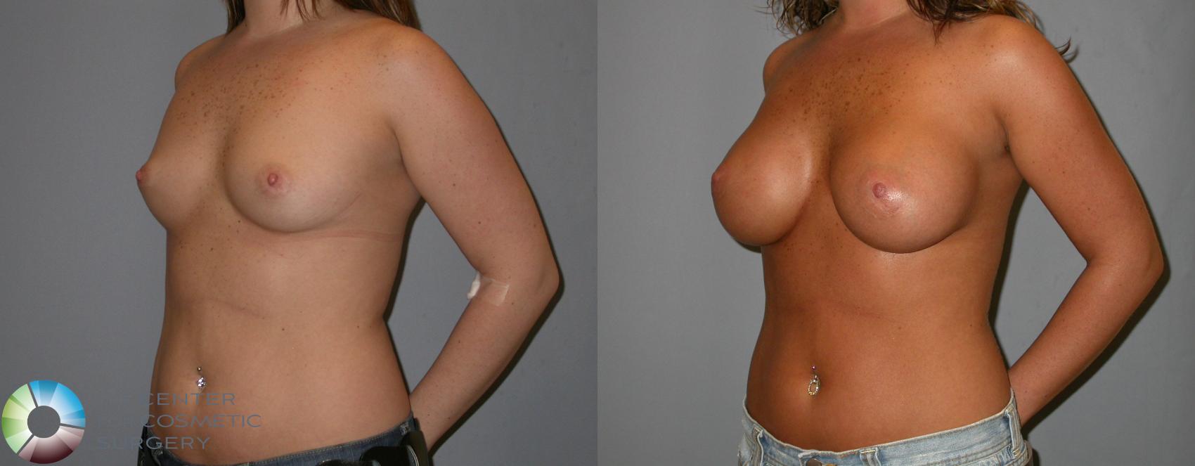 Before & After Breast Augmentation Case 139 View #1 in Denver, CO