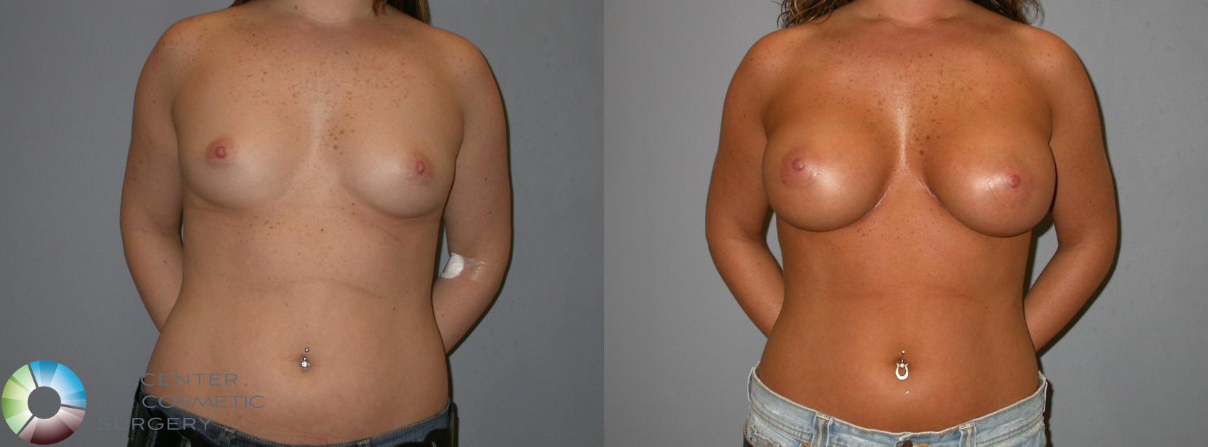 Before & After Breast Augmentation Case 139 View #2 in Denver and Colorado Springs, CO