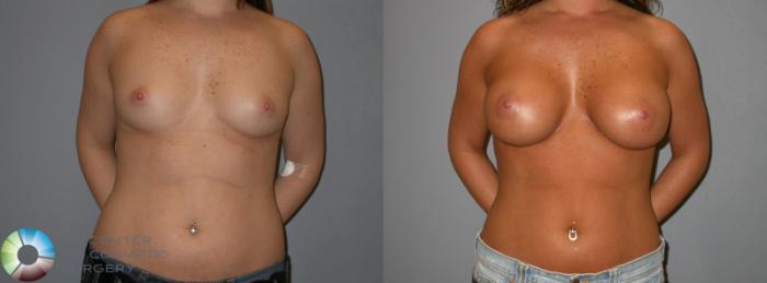 Before & After Breast Augmentation Case 139 View #2 View in Golden, CO