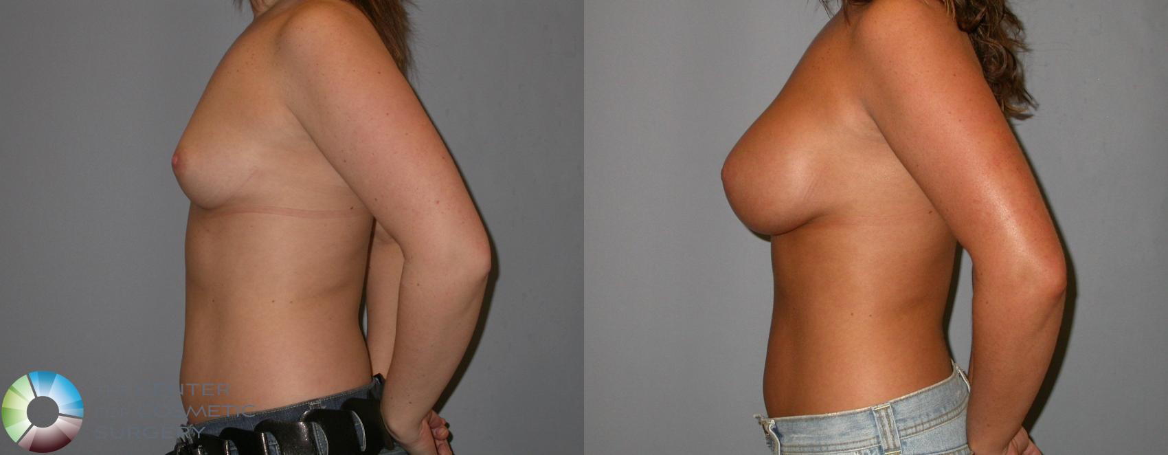 Before & After Breast Augmentation Case 139 View #3 in Denver and Colorado Springs, CO