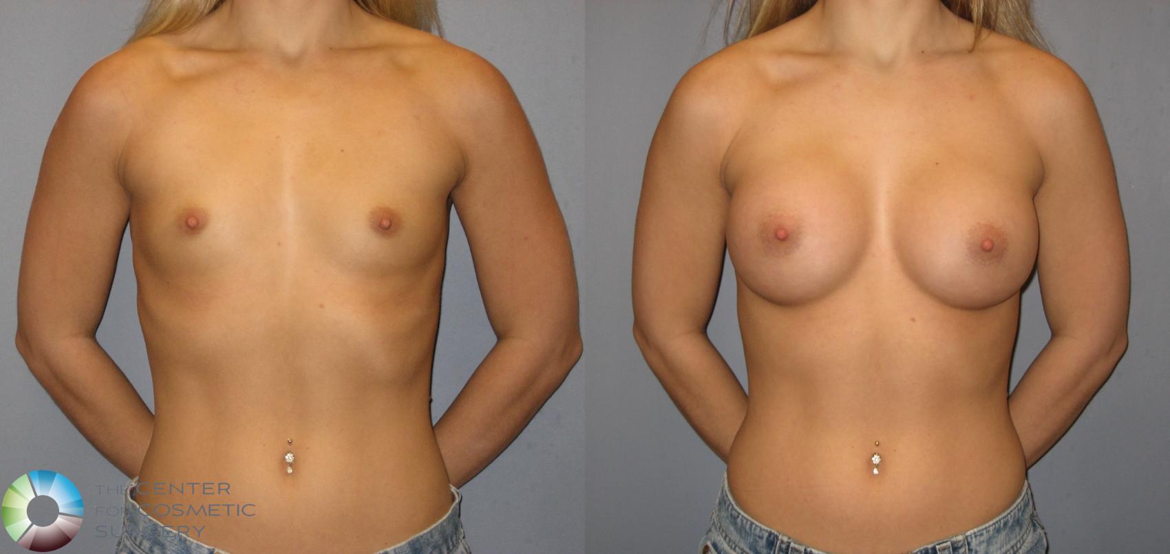 Before & After Breast Augmentation Case 140 View #1 in Denver and Colorado Springs, CO