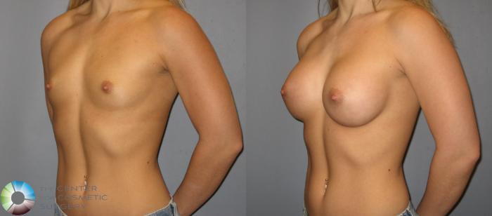 Before & After Breast Augmentation Case 140 View #2 View in Golden, CO