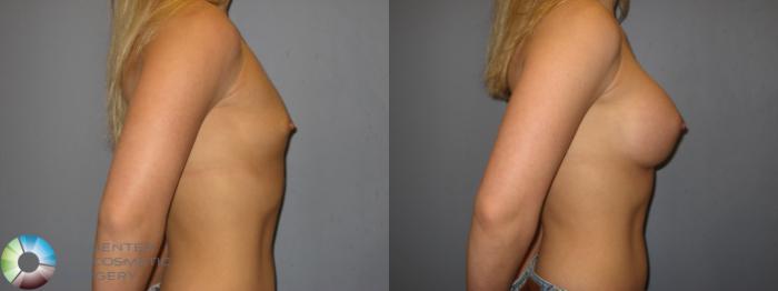 Before & After Breast Augmentation Case 140 View #3 View in Golden, CO