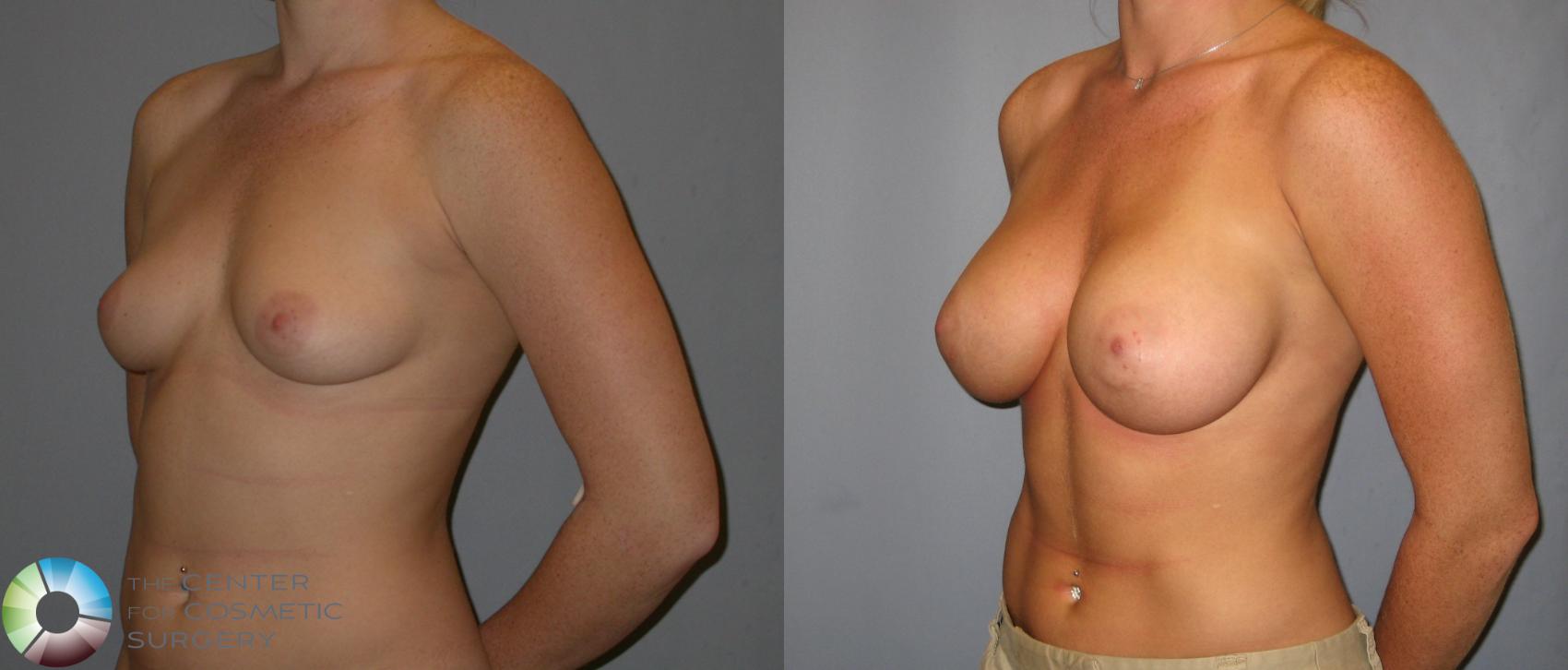 Before & After Breast Augmentation Case 143 View #1 in Denver and Colorado Springs, CO