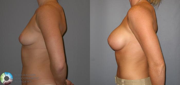 Before & After Breast Augmentation Case 143 View #2 View in Golden, CO