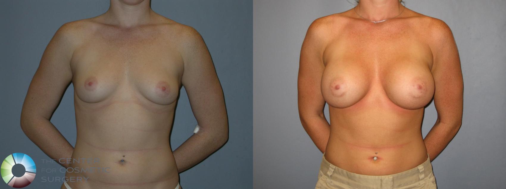 Before & After Breast Augmentation Case 143 View #3 in Denver and Colorado Springs, CO