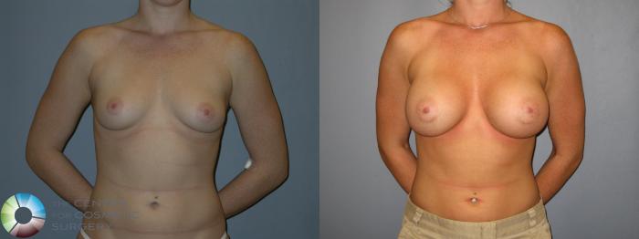 Before & After Breast Augmentation Case 143 View #3 View in Golden, CO