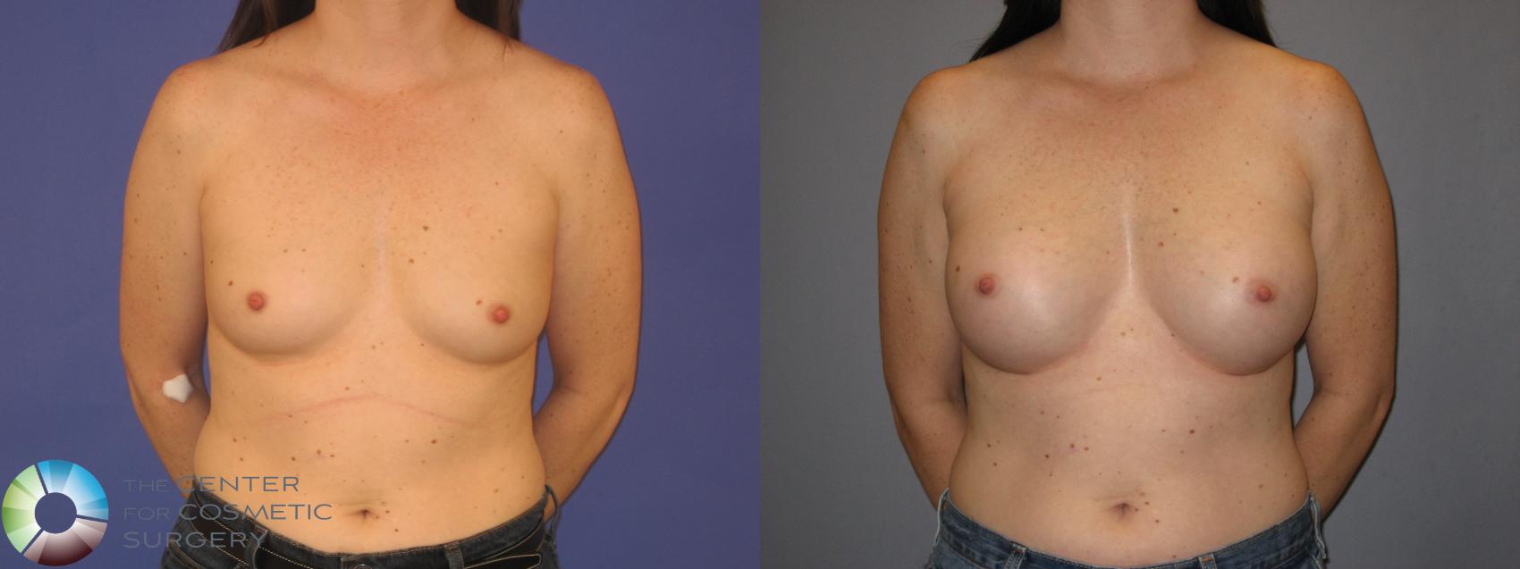 Before & After Breast Augmentation Case 144 View #1 in Denver and Colorado Springs, CO