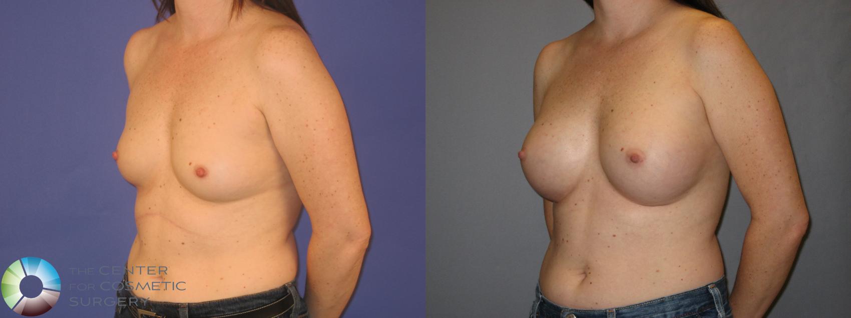 Before & After Breast Augmentation Case 144 View #2 in Denver and Colorado Springs, CO