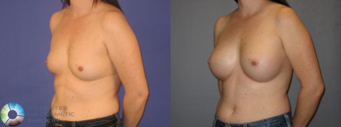 Before & After Breast Augmentation Case 144 View #2 View in Golden, CO