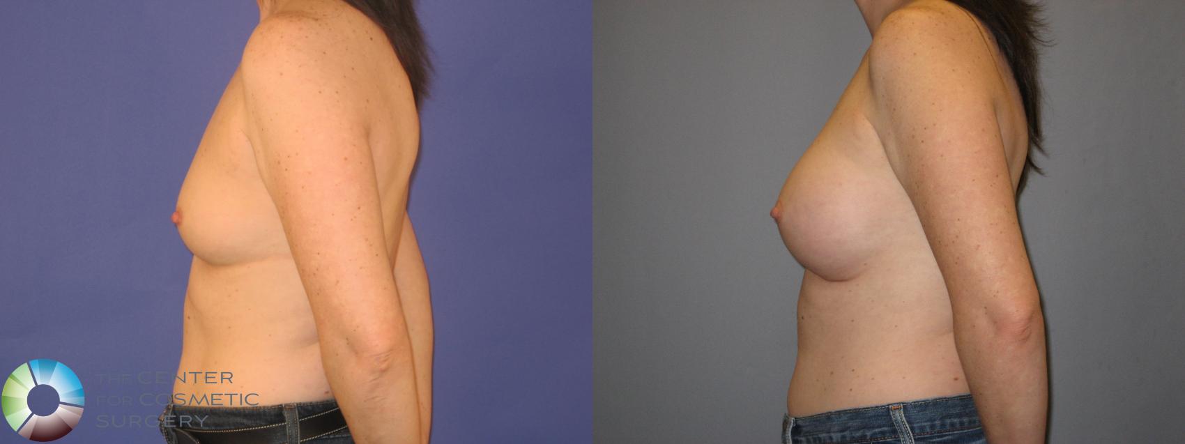 Before & After Breast Augmentation Case 144 View #3 in Denver and Colorado Springs, CO