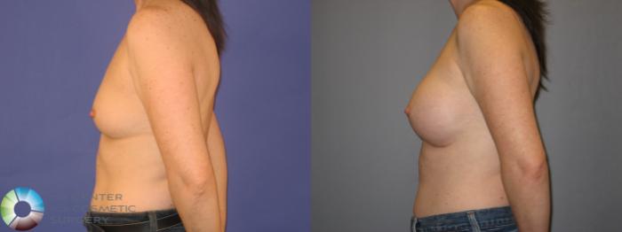 Before & After Breast Augmentation Case 144 View #3 View in Golden, CO