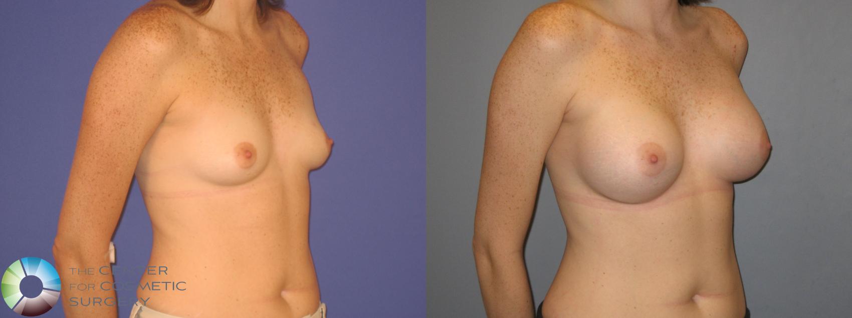 Before & After Breast Augmentation Case 156 View #1 in Denver and Colorado Springs, CO