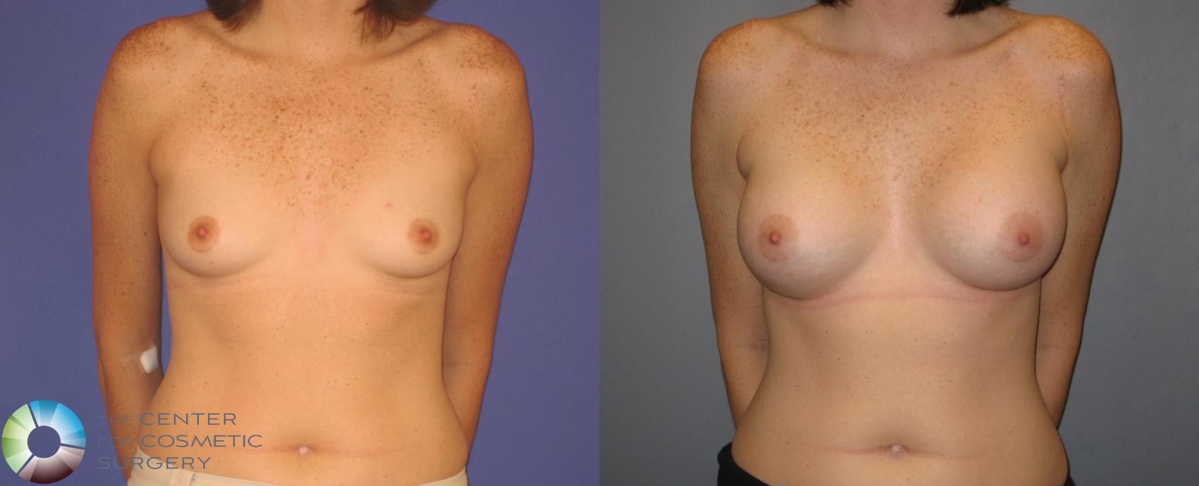 Before & After Breast Augmentation Case 156 View #2 in Denver and Colorado Springs, CO