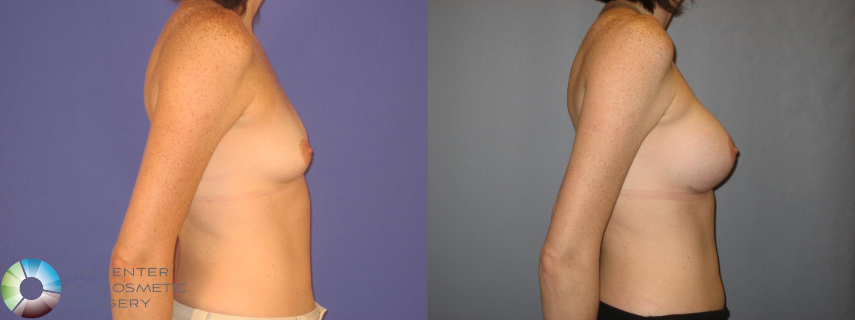 Before & After Breast Augmentation Case 156 View #3 in Denver and Colorado Springs, CO