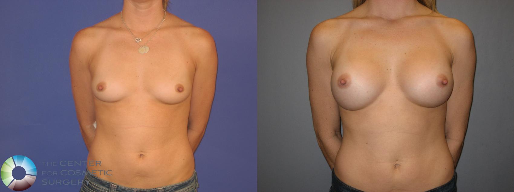 Before & After Breast Augmentation Case 168 View #1 in Denver and Colorado Springs, CO