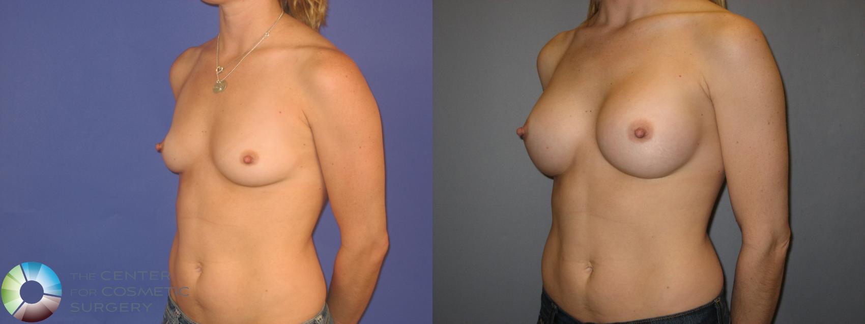 Before & After Breast Augmentation Case 168 View #2 in Denver and Colorado Springs, CO