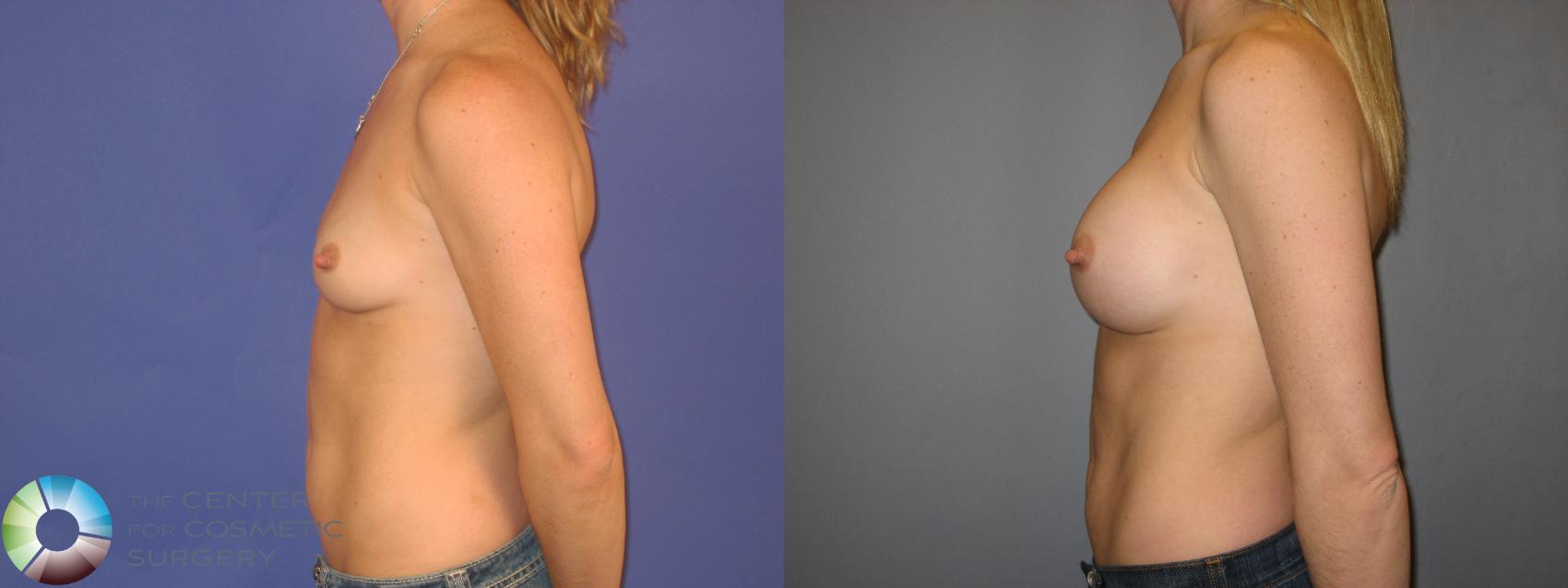 Before & After Breast Augmentation Case 168 View #3 in Denver and Colorado Springs, CO