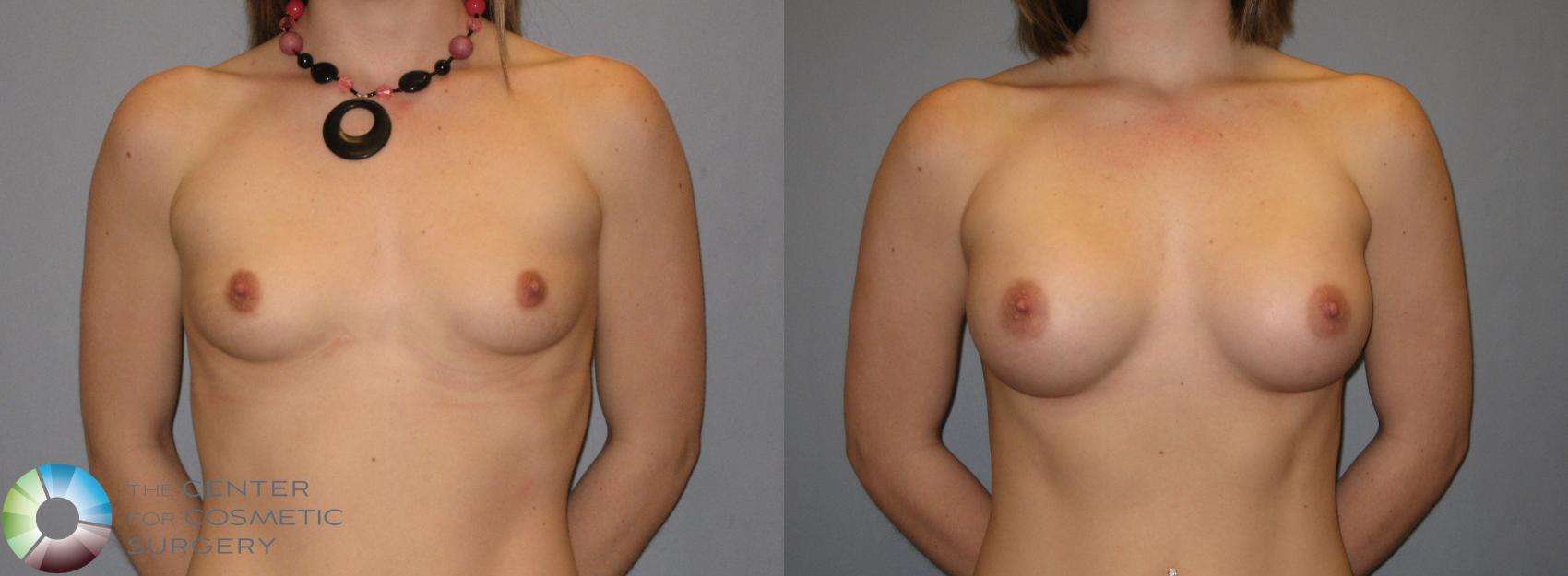 Before & After Breast Augmentation Case 169 View #1 in Denver and Colorado Springs, CO