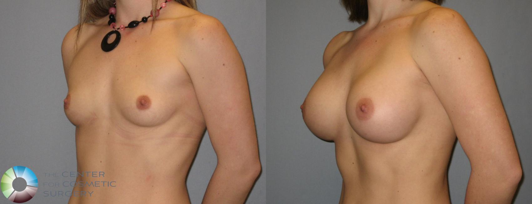 Before & After Breast Augmentation Case 169 View #2 in Denver and Colorado Springs, CO