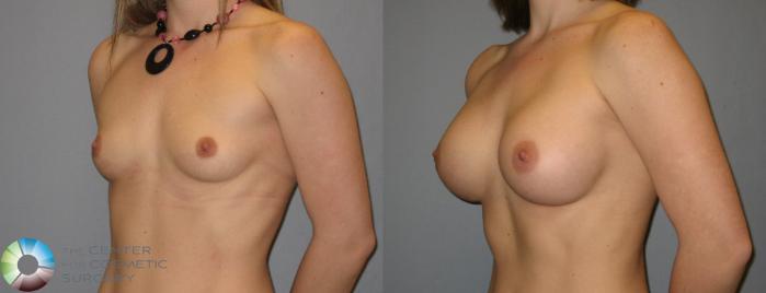 Before & After Breast Augmentation Case 169 View #2 View in Golden, CO