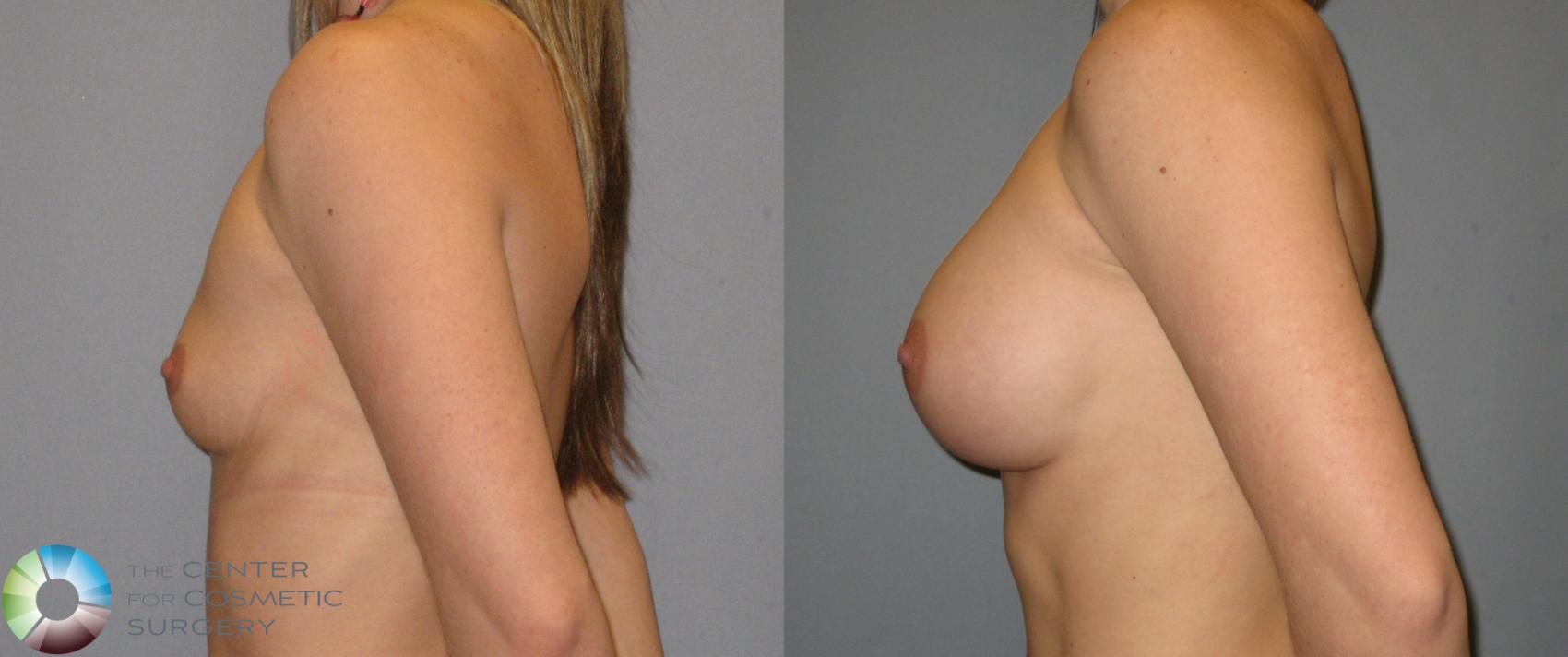 Before & After Breast Augmentation Case 169 View #3 in Denver and Colorado Springs, CO