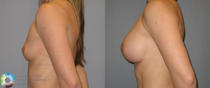 Before & After Breast Augmentation Case 169 View #3 View in Golden, CO