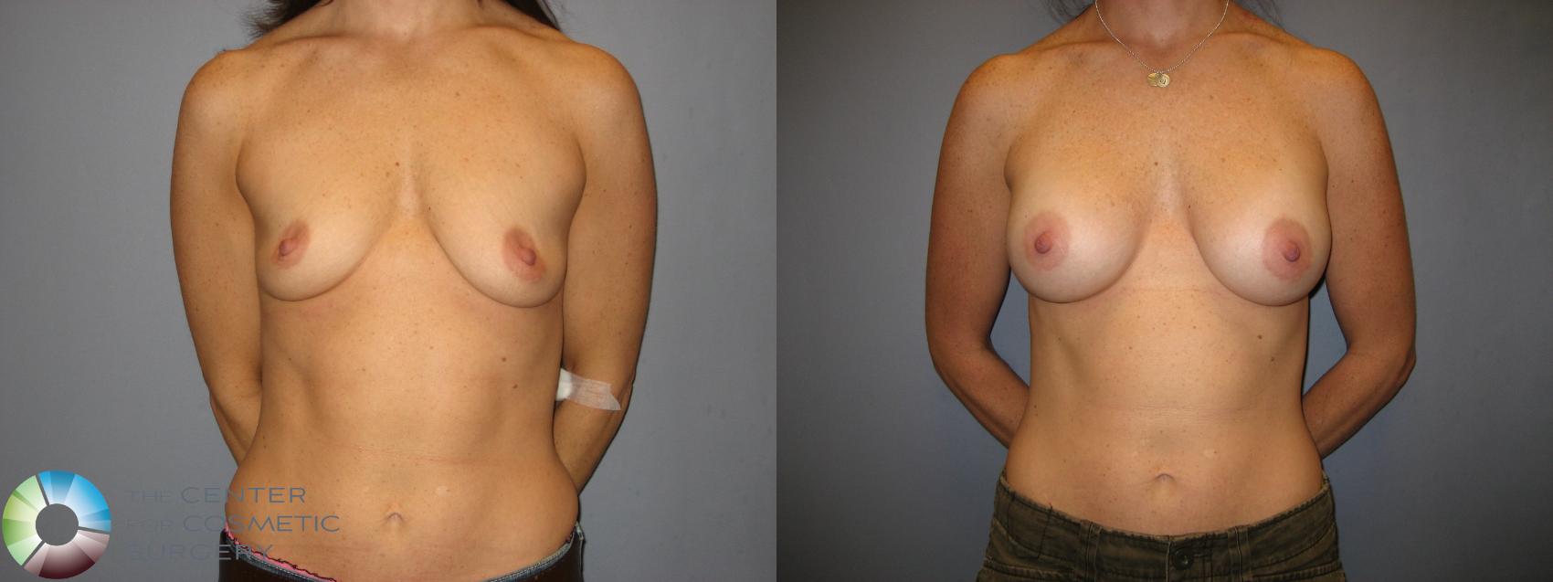 Before & After Breast Augmentation Case 170 View #1 in Denver, CO