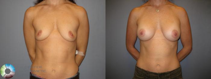 Before & After Breast Augmentation Case 170 View #1 View in Golden, CO