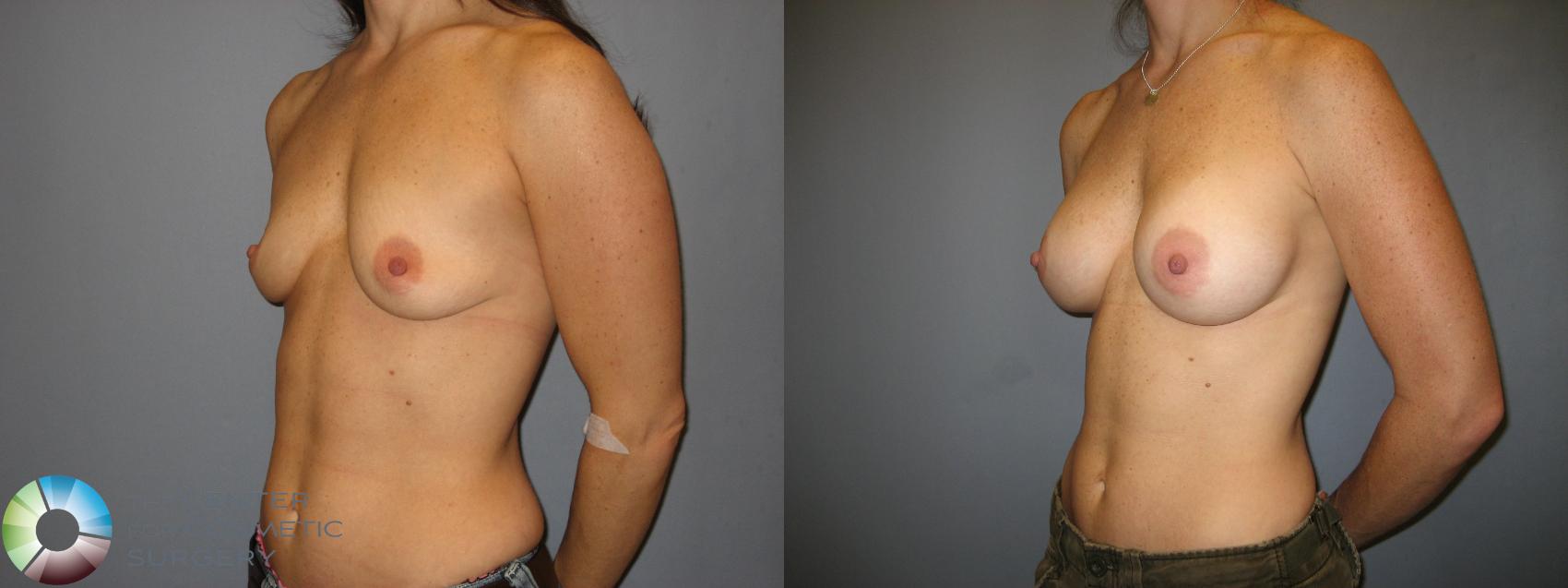 Before & After Breast Augmentation Case 170 View #2 View in Golden, CO