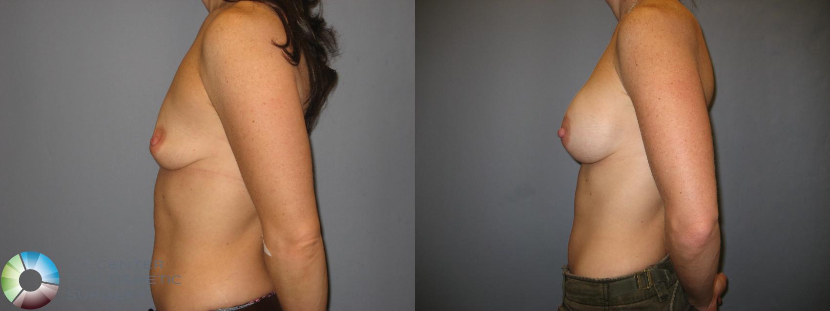 Before & After Breast Augmentation Case 170 View #3 View in Golden, CO