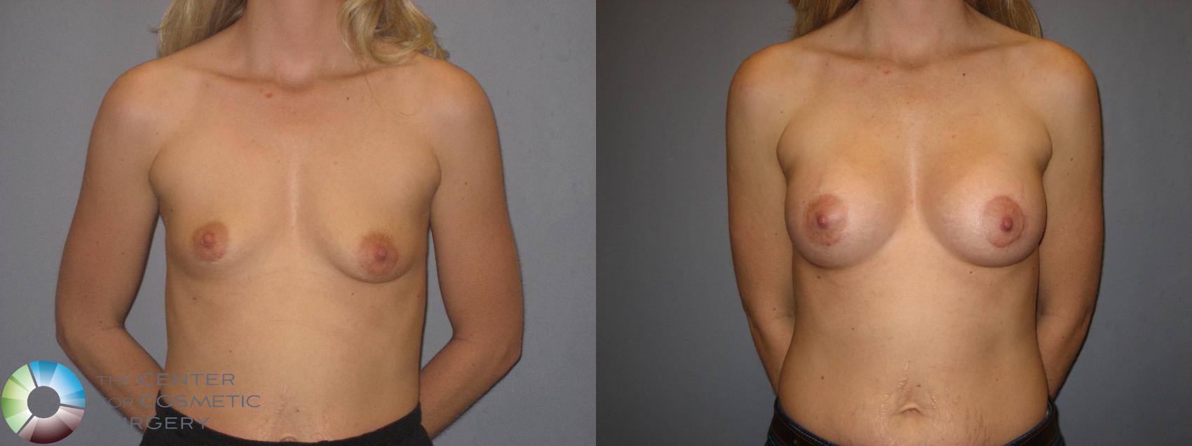 Before & After Breast Augmentation Case 171 View #1 View in Golden, CO