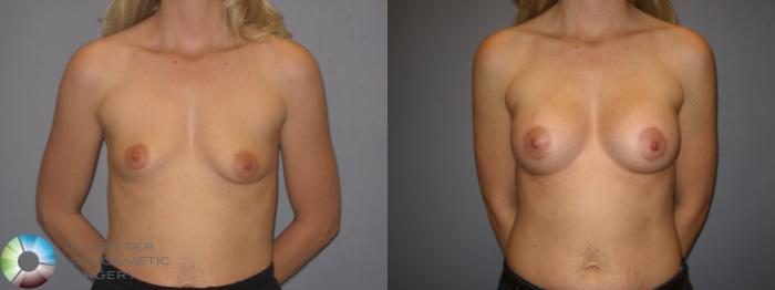 Before & After Breast Augmentation Case 171 View #1 View in Golden, CO