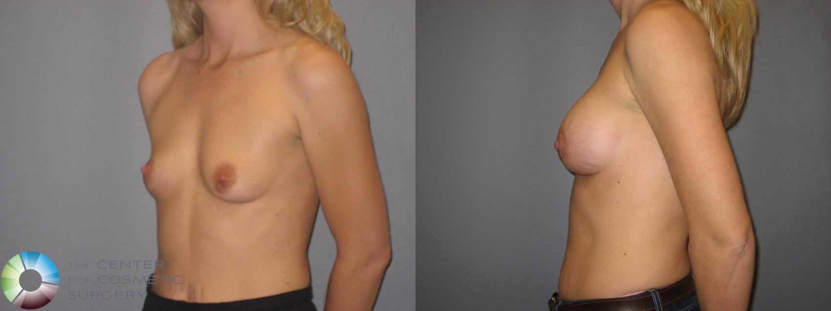 Before & After Breast Augmentation Case 171 View #2 in Denver and Colorado Springs, CO