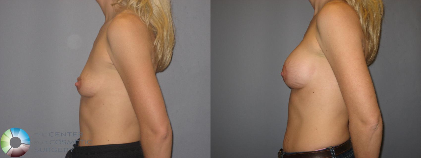 Before & After Breast Augmentation Case 171 View #3 in Denver and Colorado Springs, CO