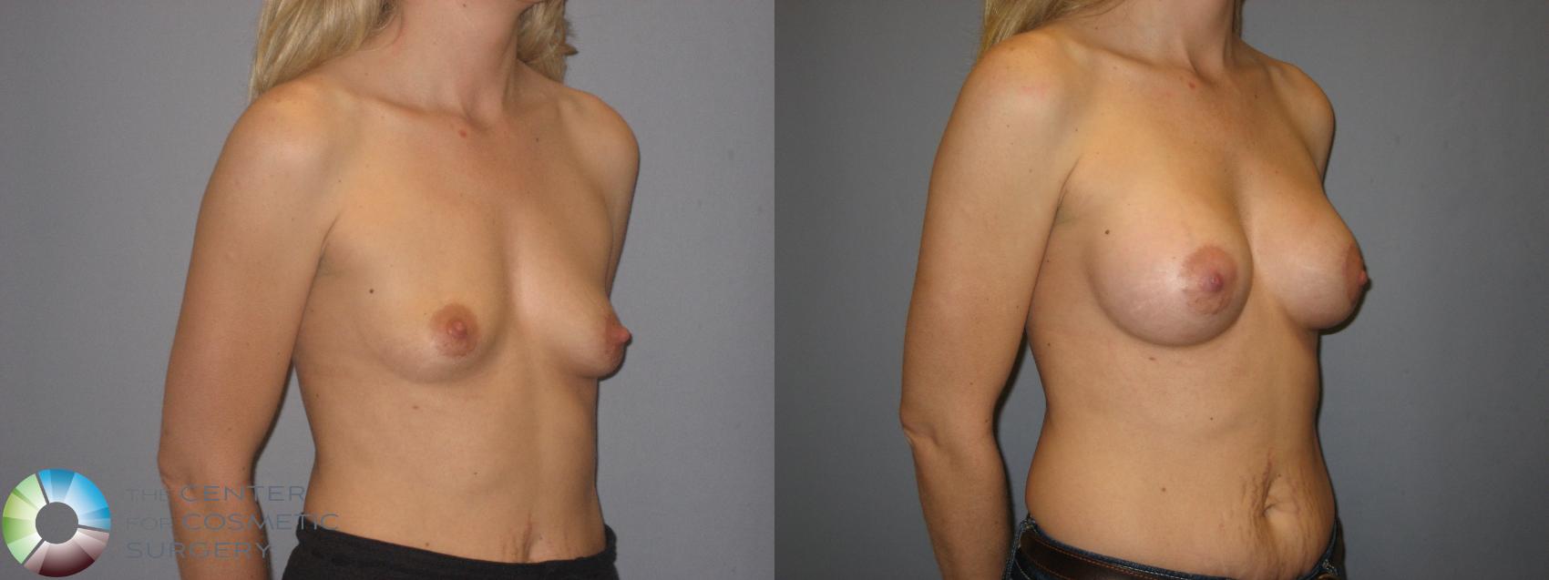 Before & After Breast Augmentation Case 171 View #4 in Denver and Colorado Springs, CO