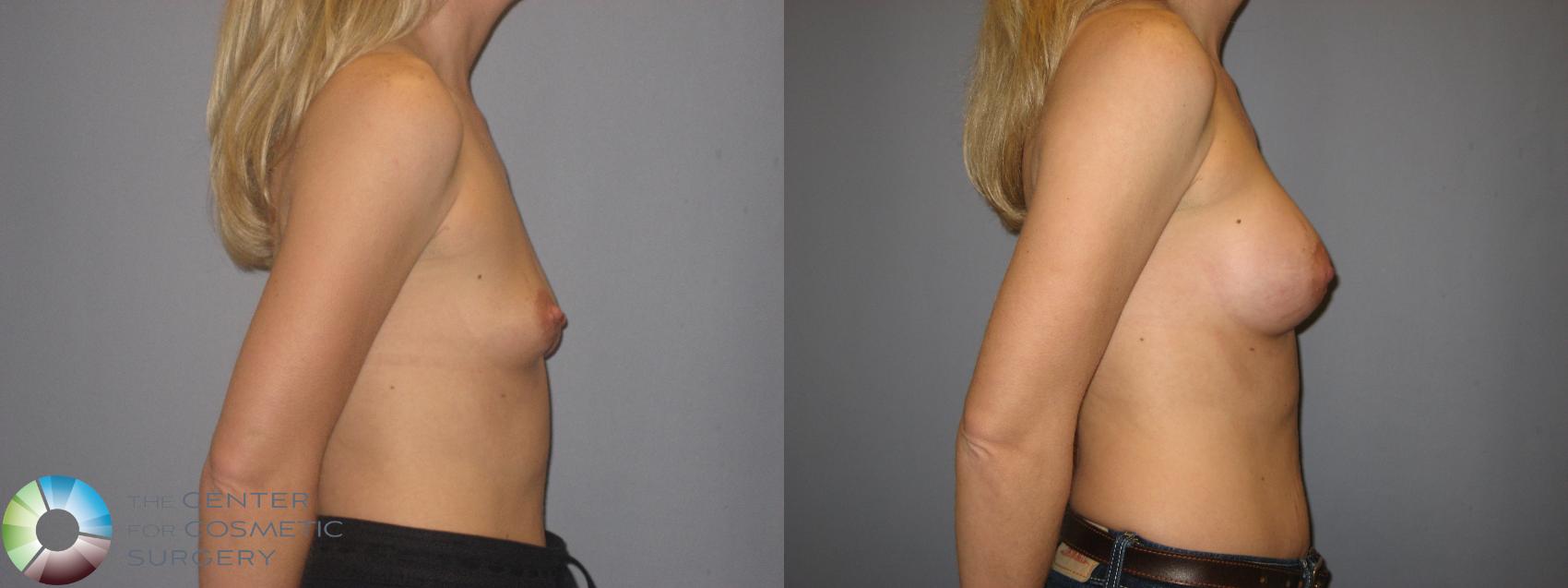 Before & After Breast Augmentation Case 171 View #5 in Denver and Colorado Springs, CO