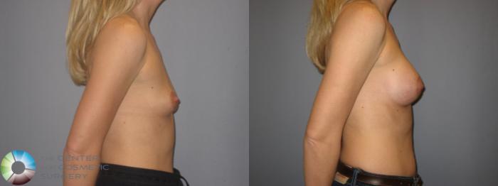 Before & After Breast Augmentation Case 171 View #5 View in Golden, CO
