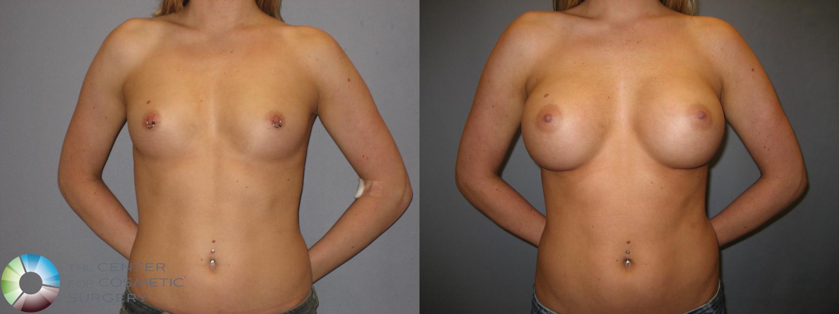 Before & After Breast Augmentation Case 172 View #1 in Denver, CO