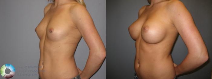 Before & After Breast Augmentation Case 172 View #2 in Denver, CO