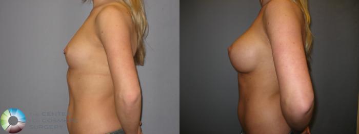 Before & After Breast Augmentation Case 172 View #3 in Denver, CO
