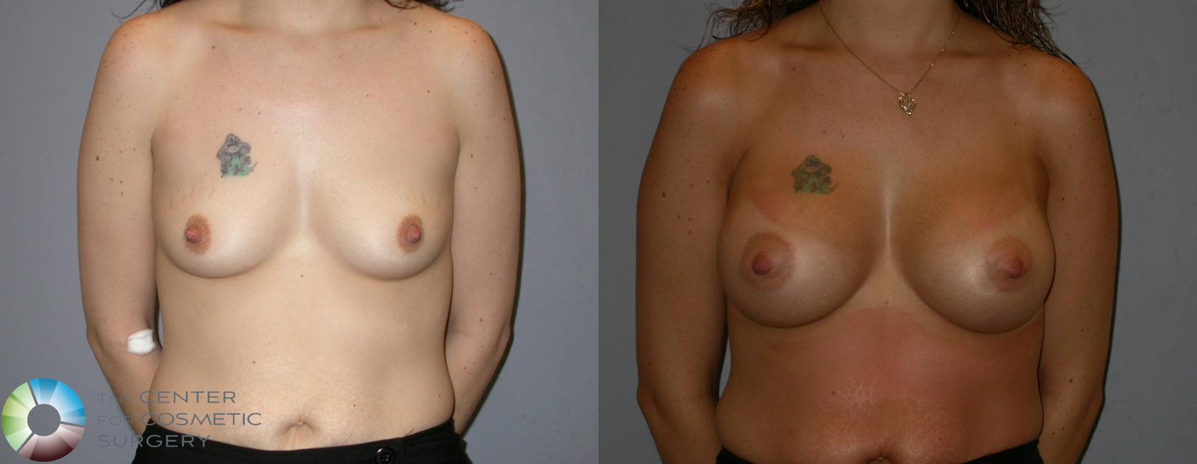 Before & After Breast Augmentation Case 173 View #1 in Denver and Colorado Springs, CO