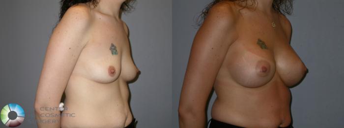 Before & After Breast Augmentation Case 173 View #2 View in Golden, CO